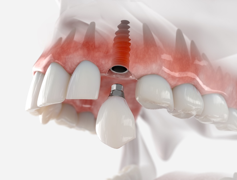 implante dental
