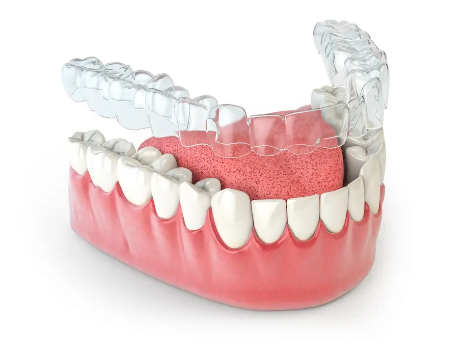 invisalign-carracedelo-maqueta